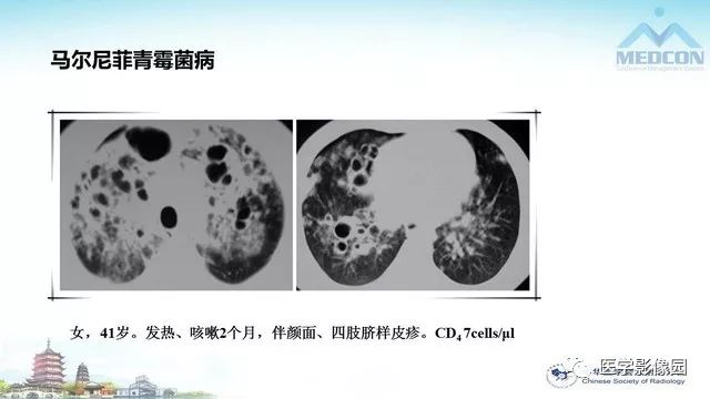 【PPT】AIDS并发播散性真菌病的CT表现