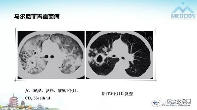 【PPT】AIDS并发播散性真菌病的CT表现