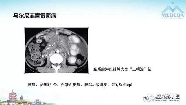 【PPT】AIDS并发播散性真菌病的CT表现