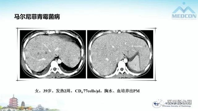 【PPT】AIDS并发播散性真菌病的CT表现