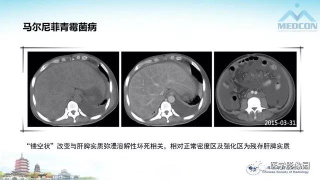 【PPT】AIDS并发播散性真菌病的CT表现