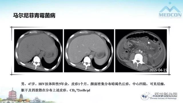 【PPT】AIDS并发播散性真菌病的CT表现