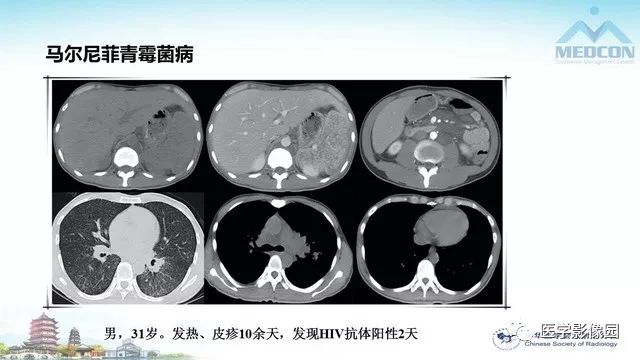 【PPT】AIDS并发播散性真菌病的CT表现