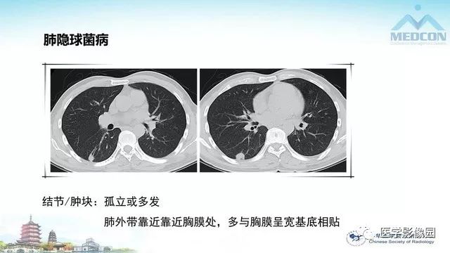 【PPT】AIDS并发播散性真菌病的CT表现