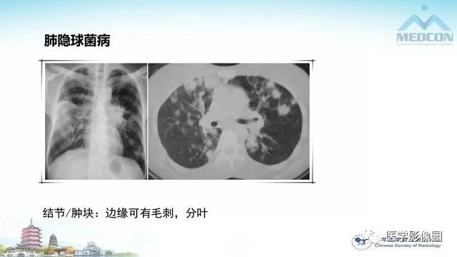 【PPT】AIDS并发播散性真菌病的CT表现