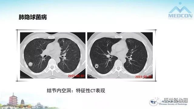 【PPT】AIDS并发播散性真菌病的CT表现