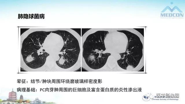 【PPT】AIDS并发播散性真菌病的CT表现