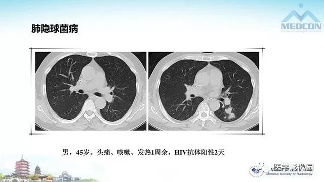 【PPT】AIDS并发播散性真菌病的CT表现