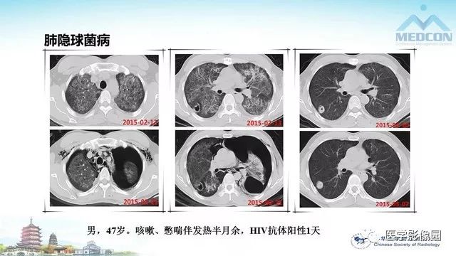 【PPT】AIDS并发播散性真菌病的CT表现