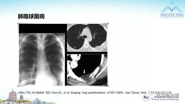 【PPT】AIDS并发播散性真菌病的CT表现