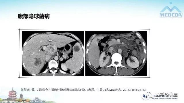 【PPT】AIDS并发播散性真菌病的CT表现