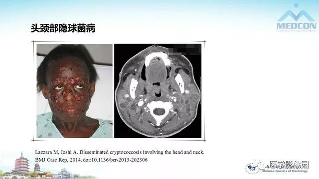 【PPT】AIDS并发播散性真菌病的CT表现