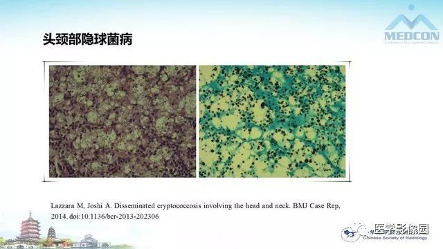 【PPT】AIDS并发播散性真菌病的CT表现