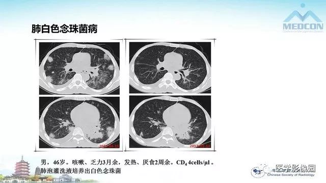 【PPT】AIDS并发播散性真菌病的CT表现