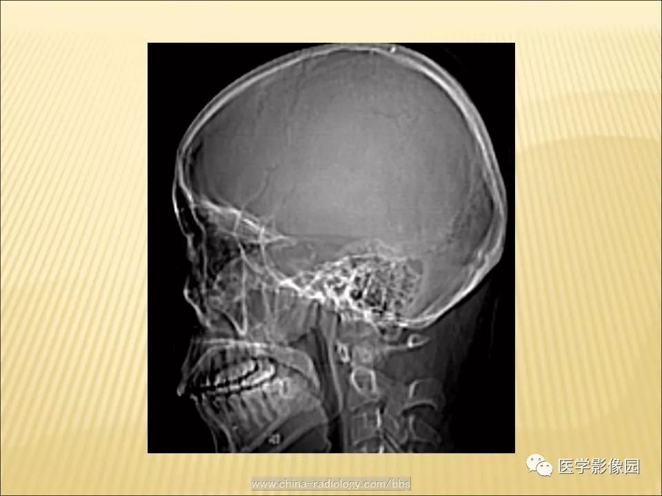 【病例】蝶窦颅咽管瘤1例CT及MR影像表现