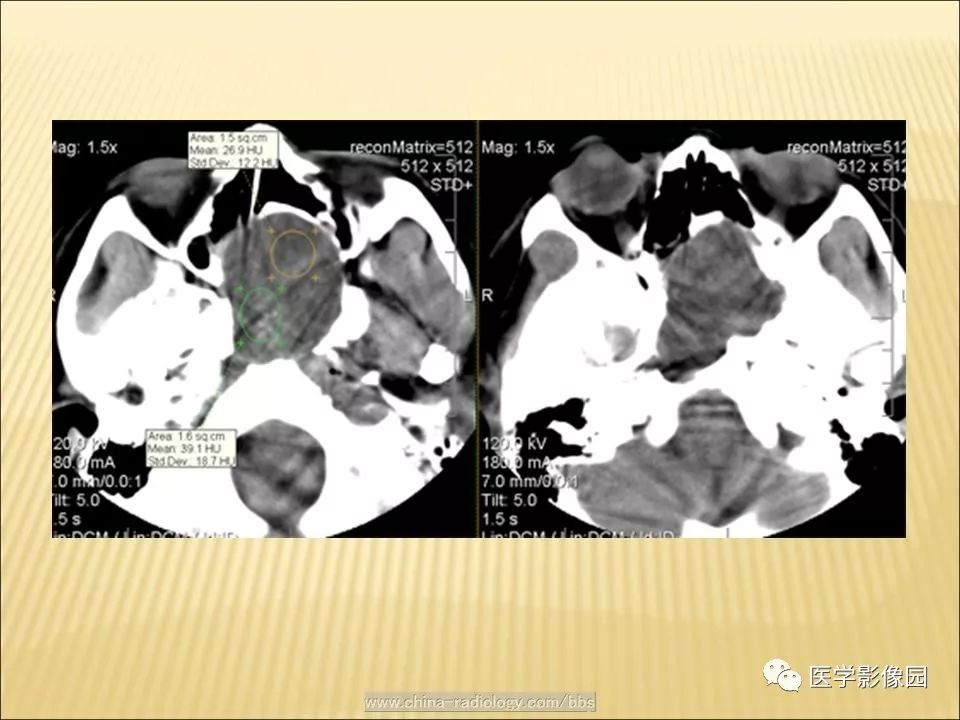 【病例】蝶窦颅咽管瘤1例CT及MR影像表现