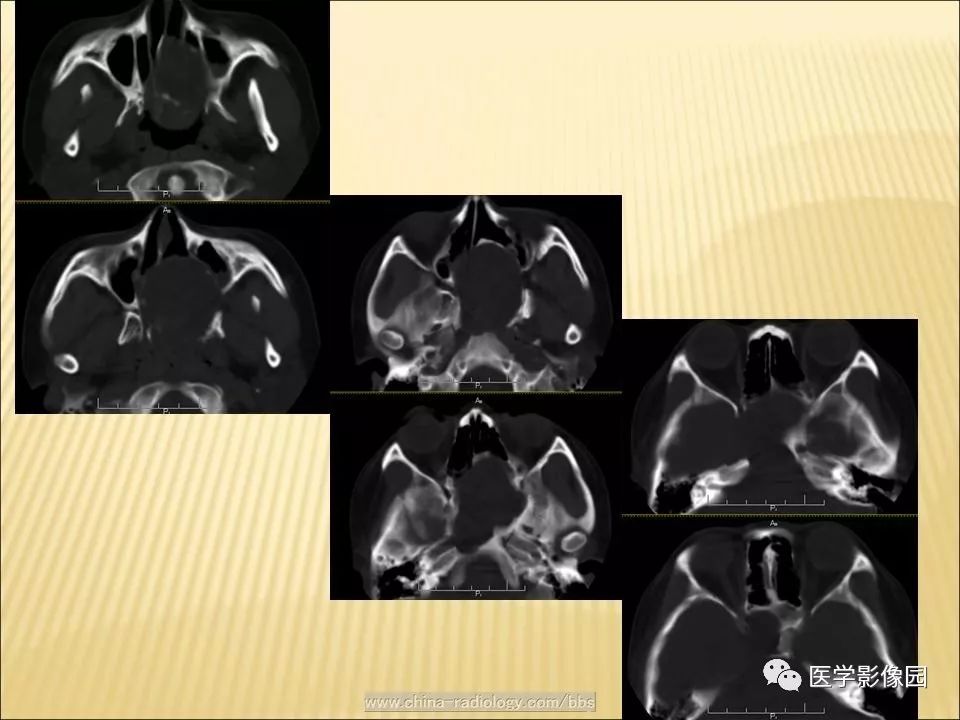 【病例】蝶窦颅咽管瘤1例CT及MR影像表现