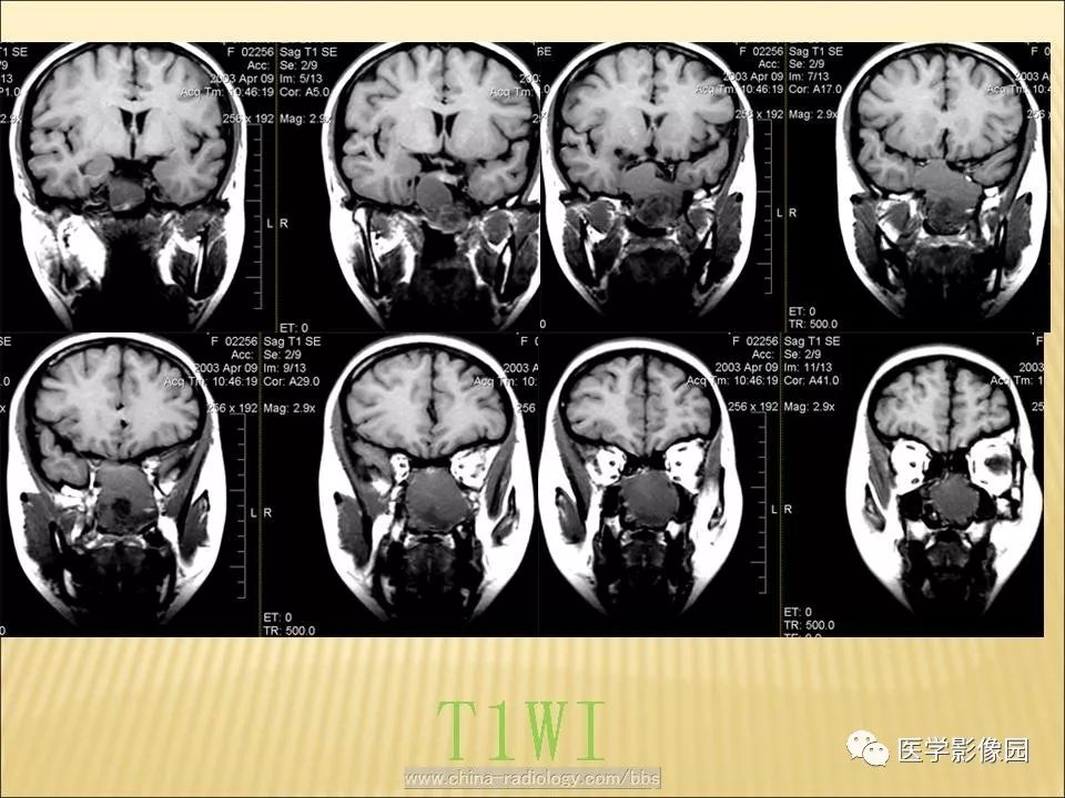 【病例】蝶窦颅咽管瘤1例CT及MR影像表现