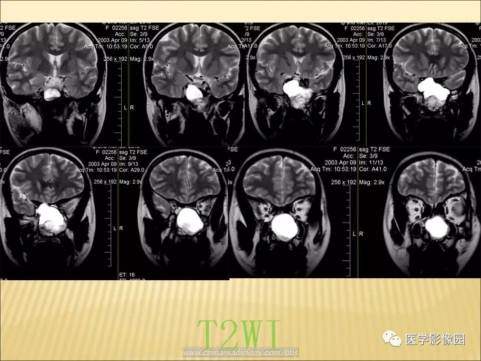 【病例】蝶窦颅咽管瘤1例CT及MR影像表现