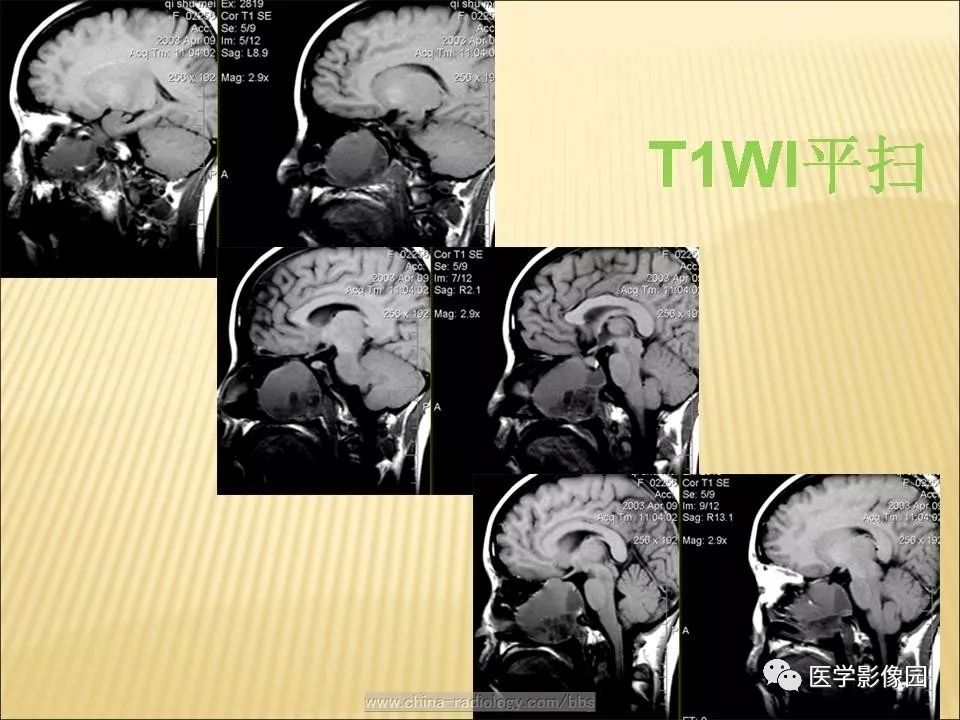【病例】蝶窦颅咽管瘤1例CT及MR影像表现