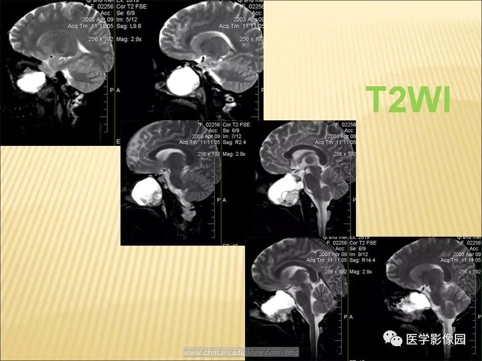【病例】蝶窦颅咽管瘤1例CT及MR影像表现