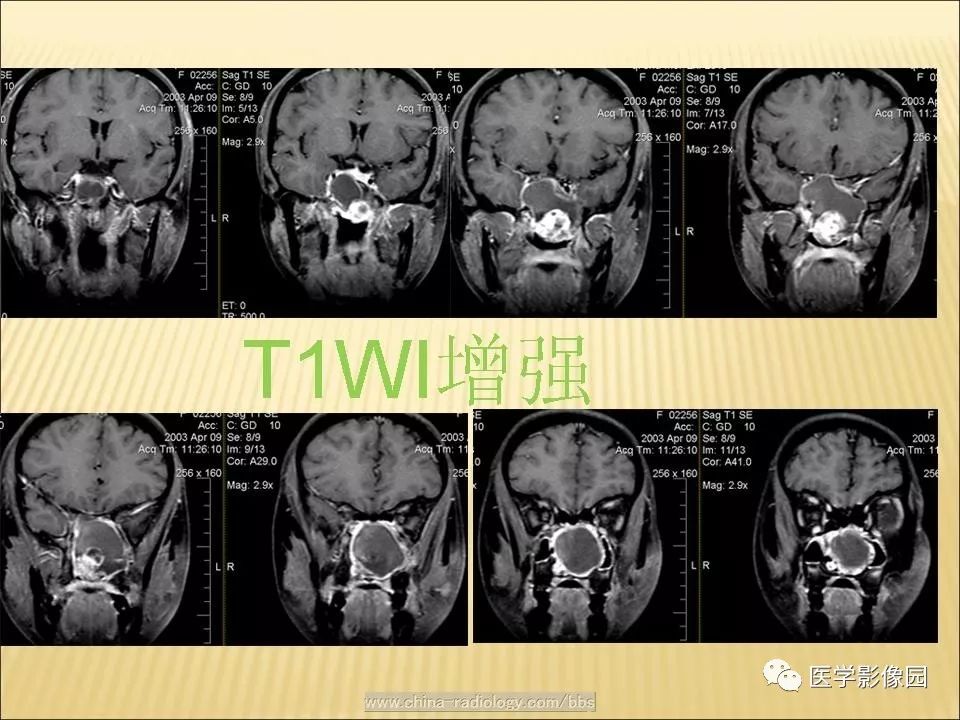 【病例】蝶窦颅咽管瘤1例CT及MR影像表现
