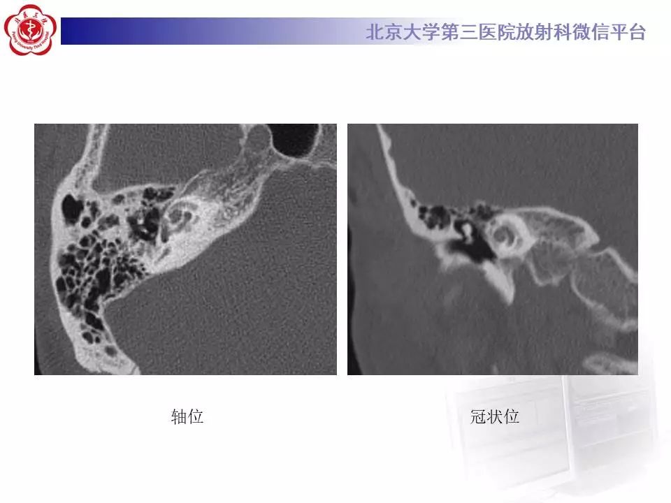 【病例】耳硬化症1例CT影像表现