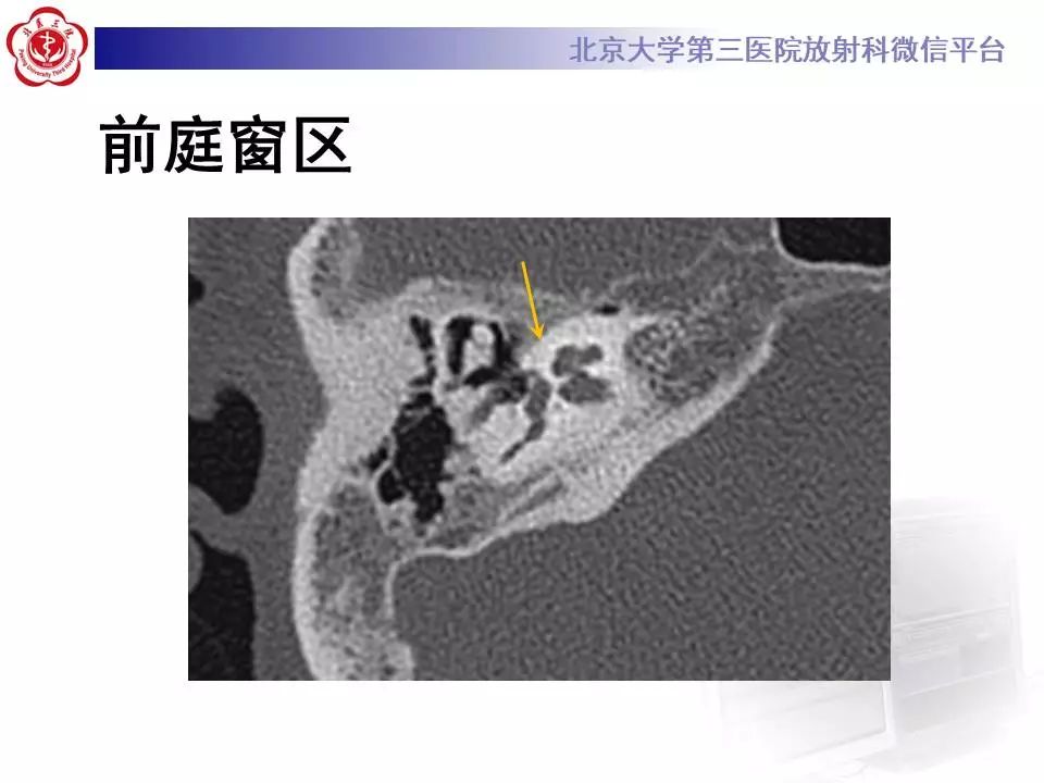 【病例】耳硬化症1例CT影像表现