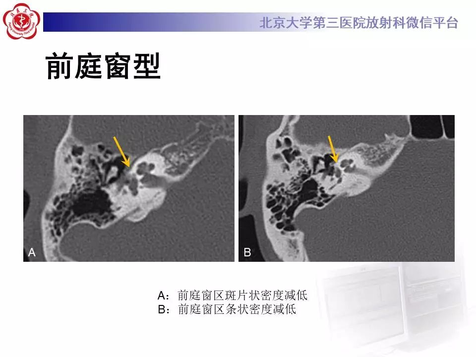【病例】耳硬化症1例CT影像表现