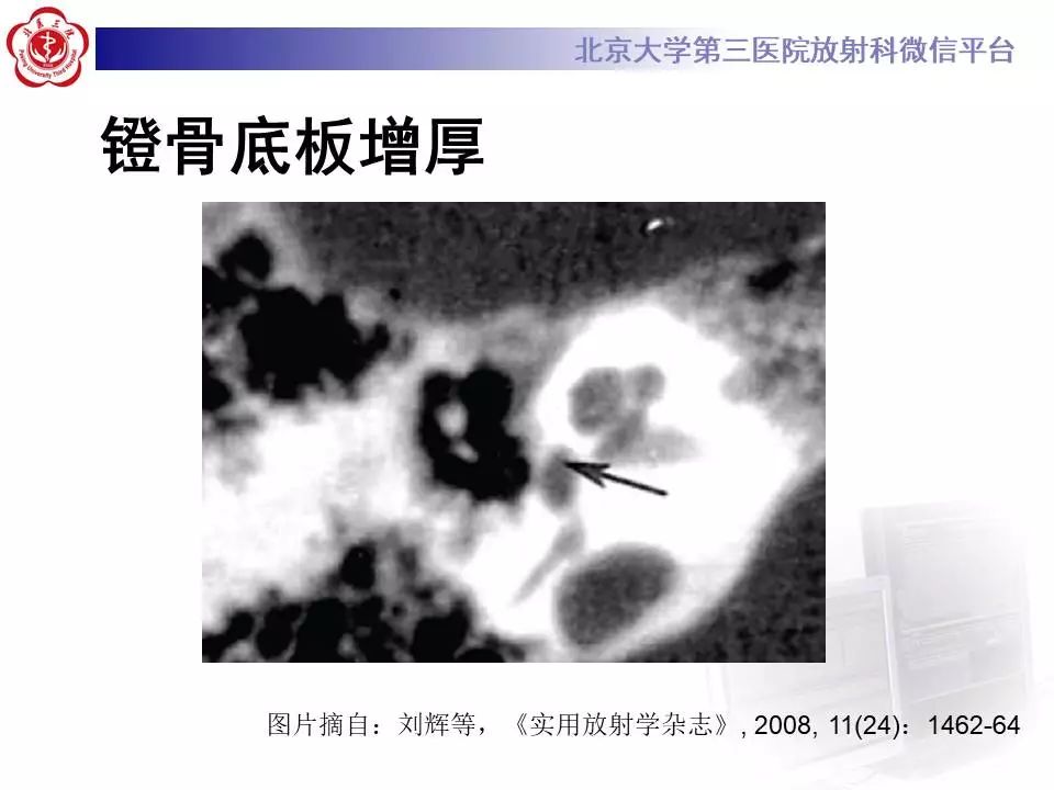 【病例】耳硬化症1例CT影像表现