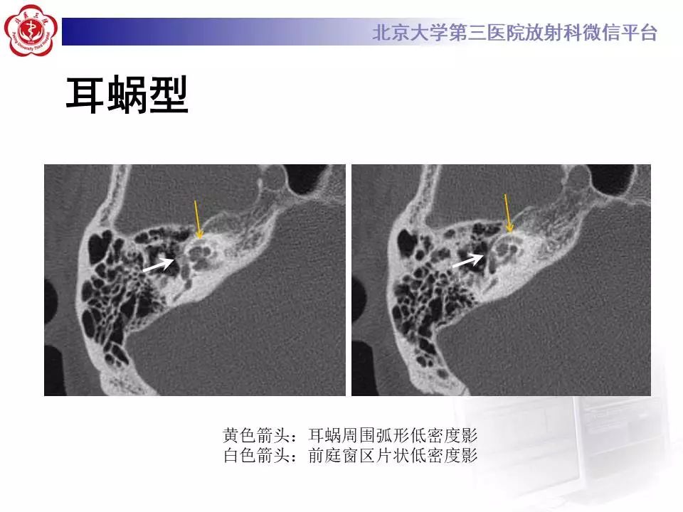 【病例】耳硬化症1例CT影像表现