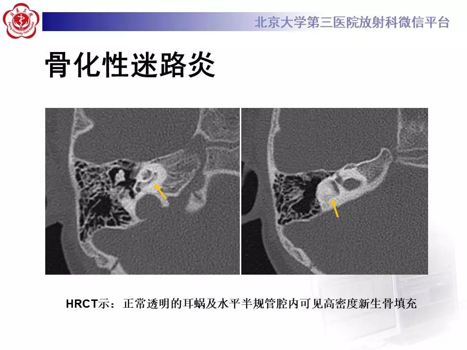 【病例】耳硬化症1例CT影像表现