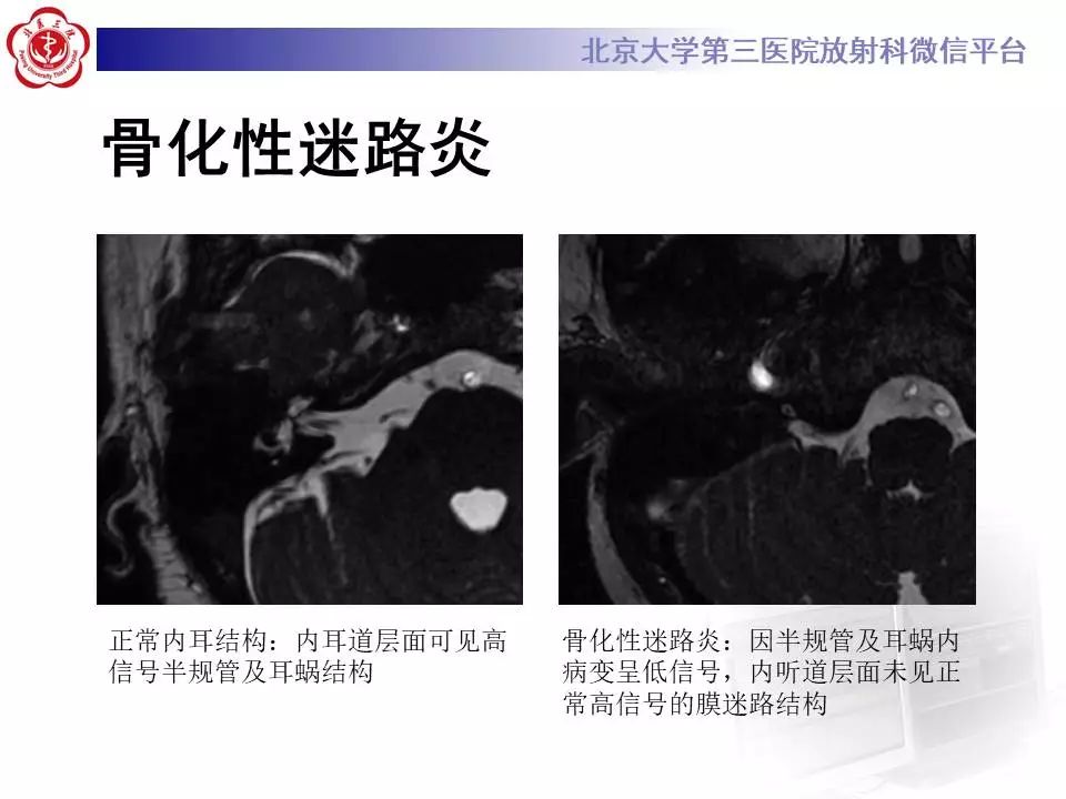 【病例】耳硬化症1例CT影像表现
