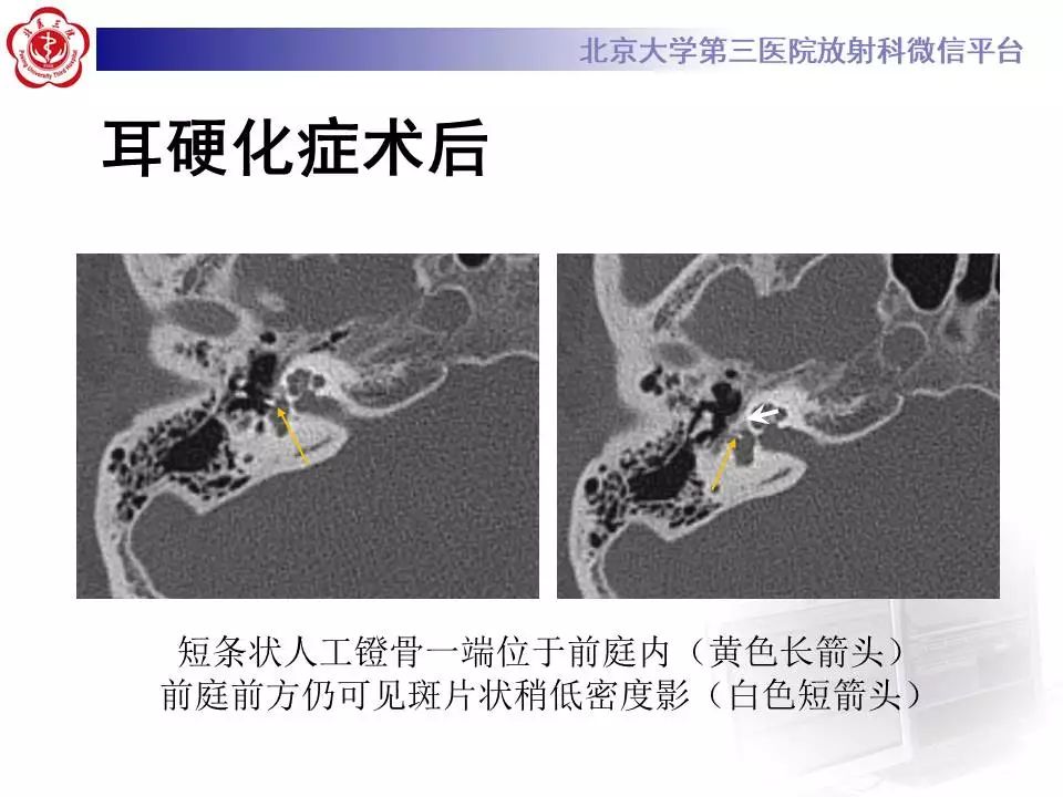 【病例】耳硬化症1例CT影像表现