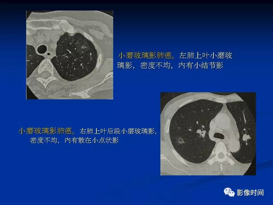 【PPT】肺内磨玻璃影的CT诊断