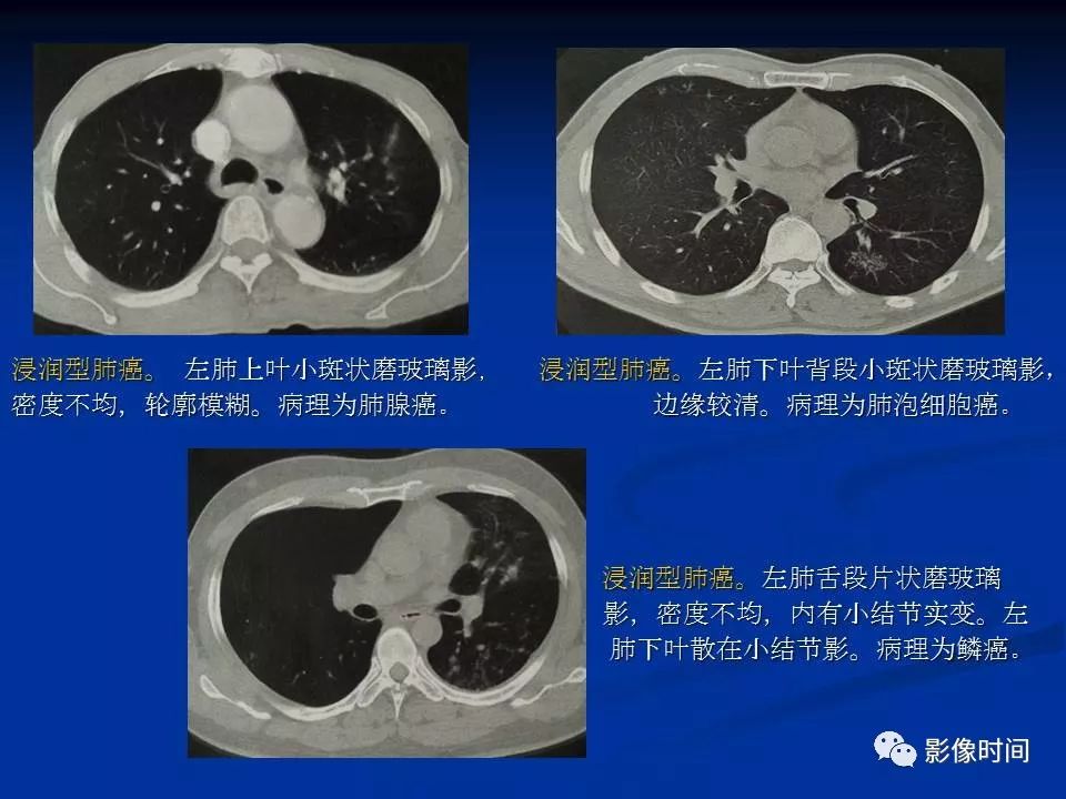 【PPT】肺内磨玻璃影的CT诊断