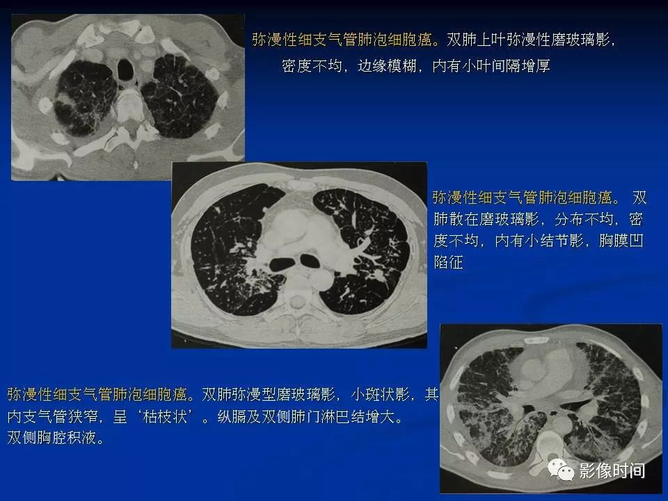 【PPT】肺内磨玻璃影的CT诊断