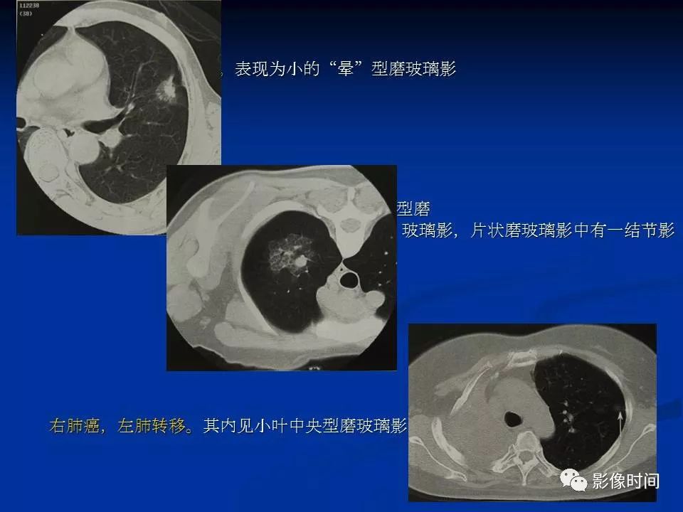 【PPT】肺内磨玻璃影的CT诊断