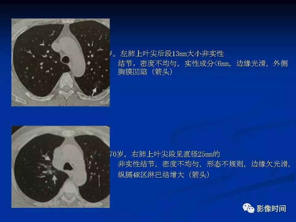 【PPT】肺内磨玻璃影的CT诊断