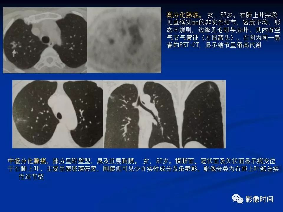 【PPT】肺内磨玻璃影的CT诊断