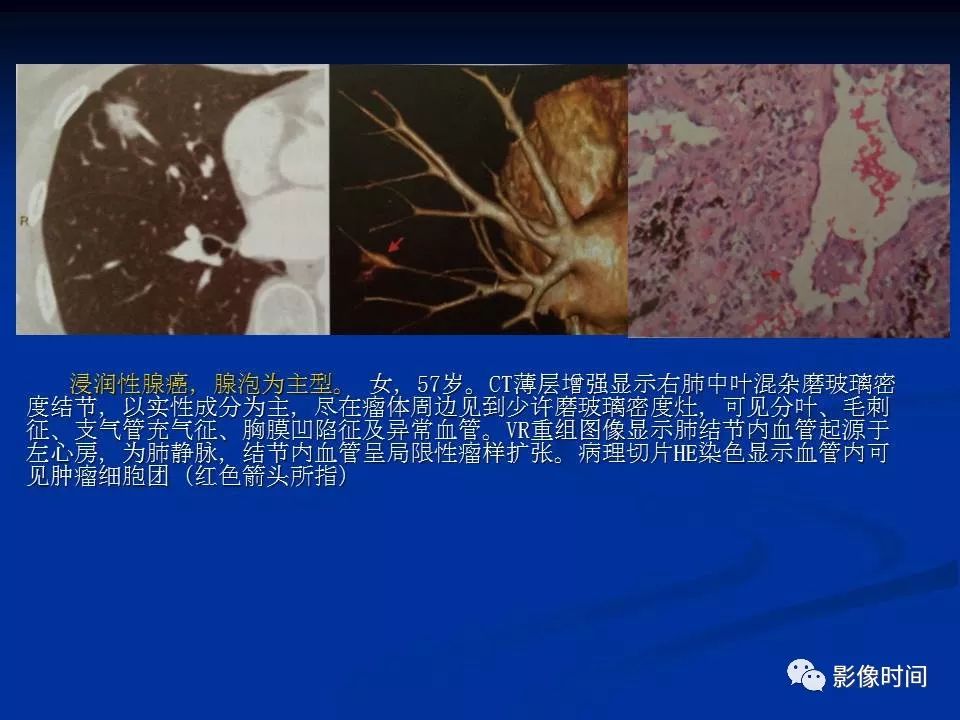 【PPT】肺内磨玻璃影的CT诊断