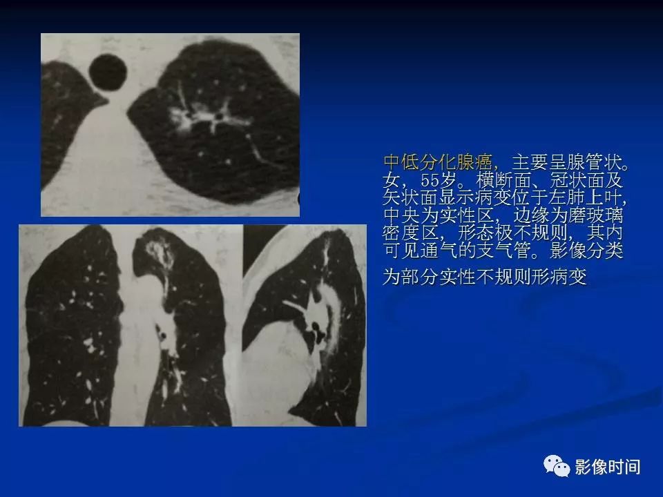 【PPT】肺内磨玻璃影的CT诊断