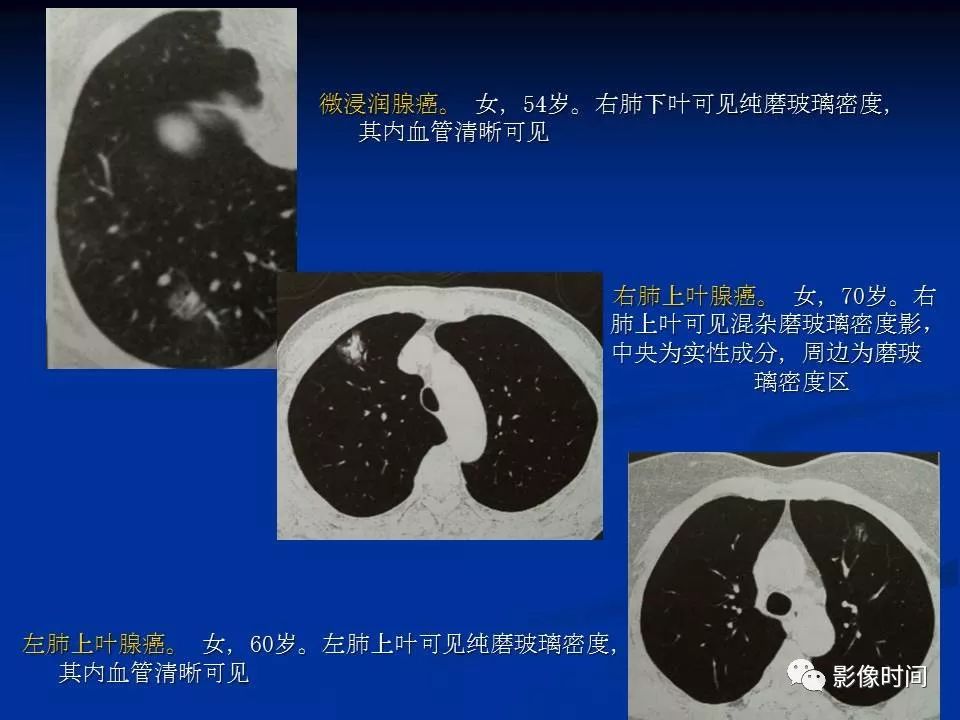 【PPT】肺内磨玻璃影的CT诊断