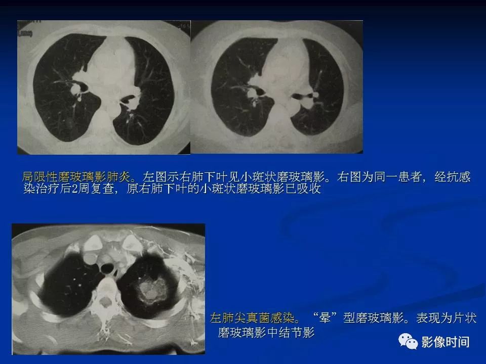 【PPT】肺内磨玻璃影的CT诊断