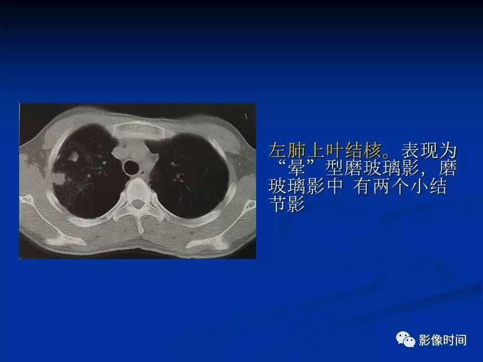 【PPT】肺内磨玻璃影的CT诊断