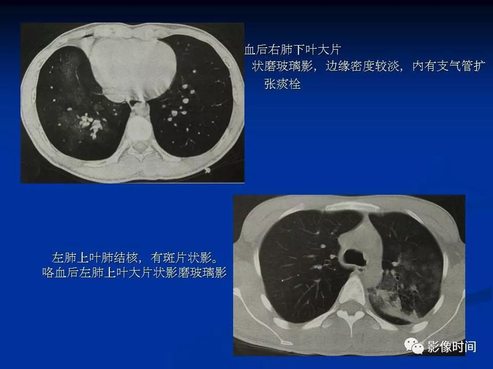 【PPT】肺内磨玻璃影的CT诊断