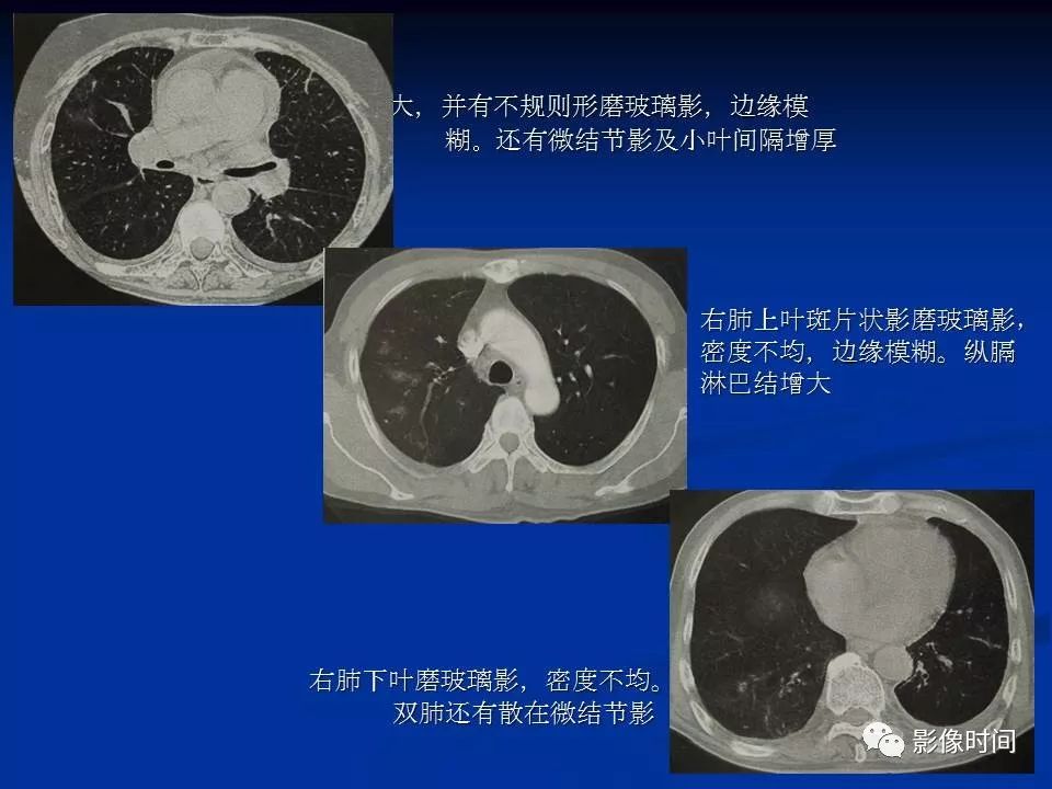 【PPT】肺内磨玻璃影的CT诊断