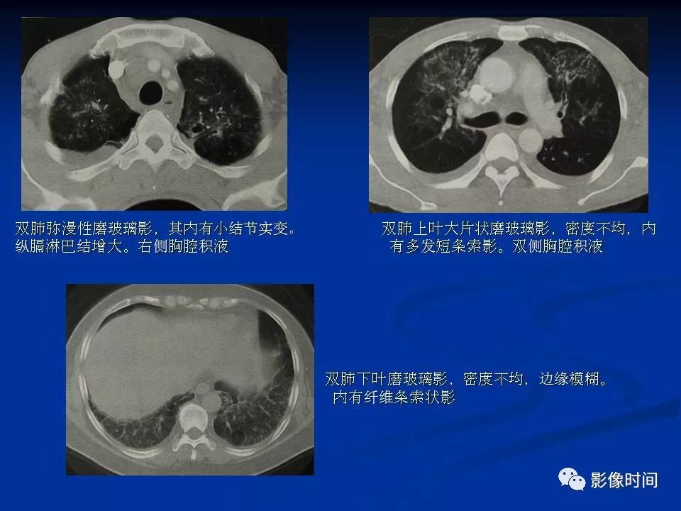 【PPT】肺内磨玻璃影的CT诊断