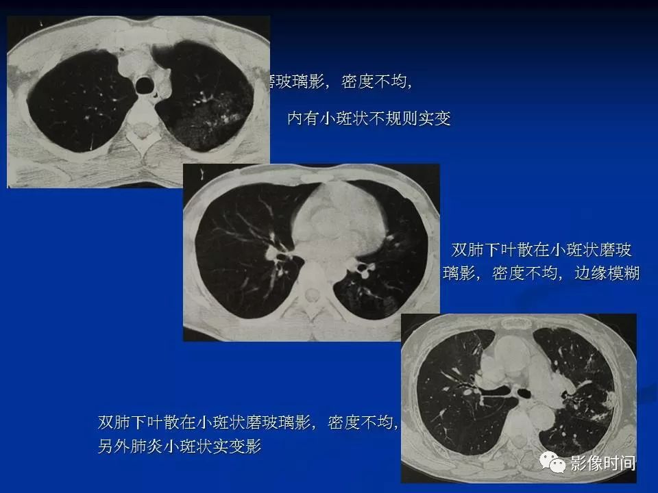 【PPT】肺内磨玻璃影的CT诊断