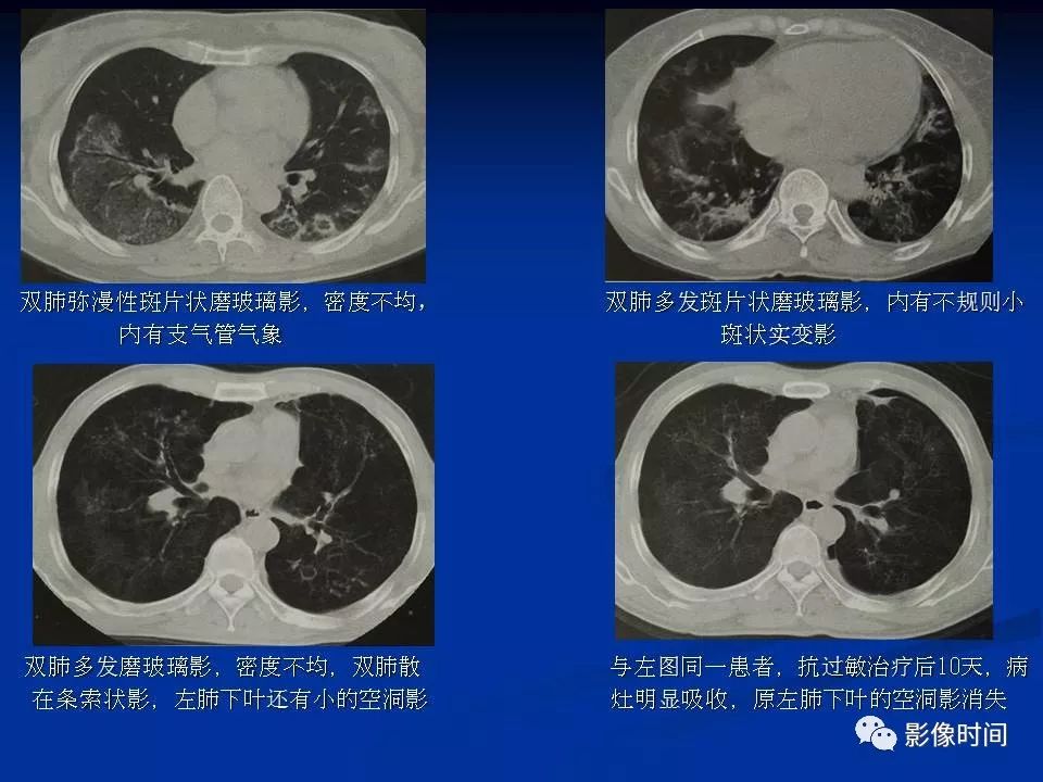 【PPT】肺内磨玻璃影的CT诊断